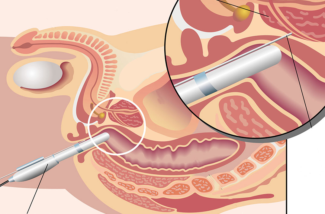 biopsies de prostate