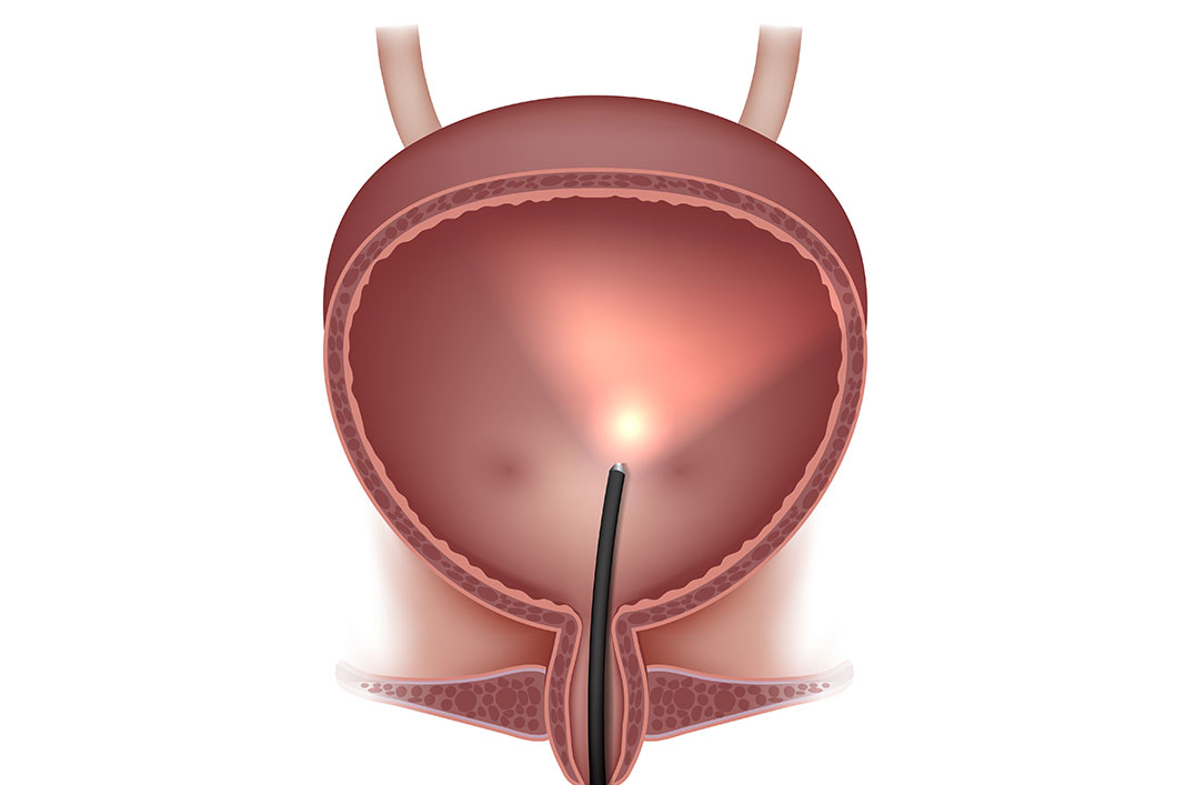 résection endoscopique vessie